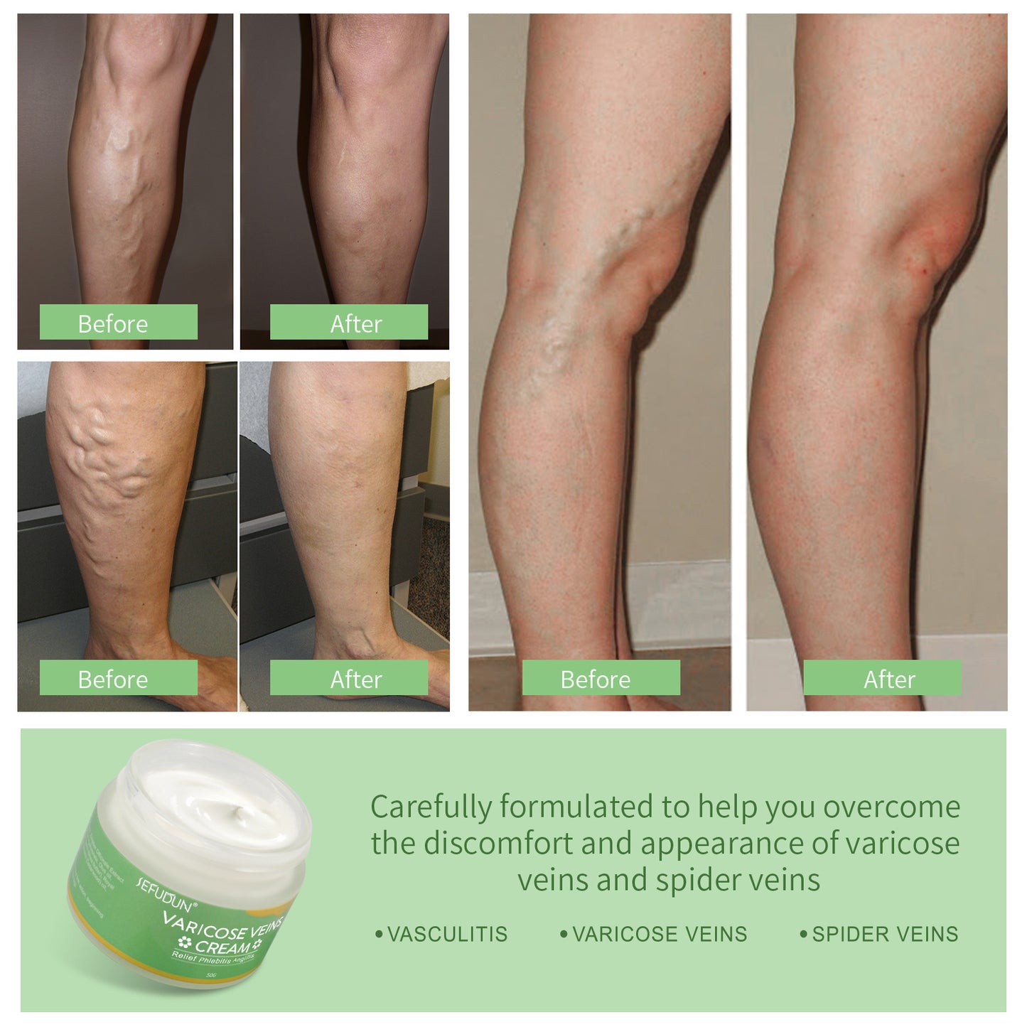Vena Crema per Vene Varicose